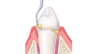 Excellent dental health starts with prophylactics